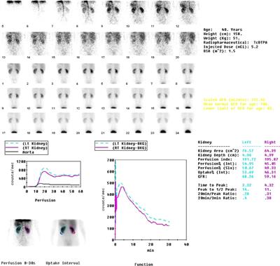 Case report: Castleman’s disease involving the renal sinus resembling renal cell carcinoma